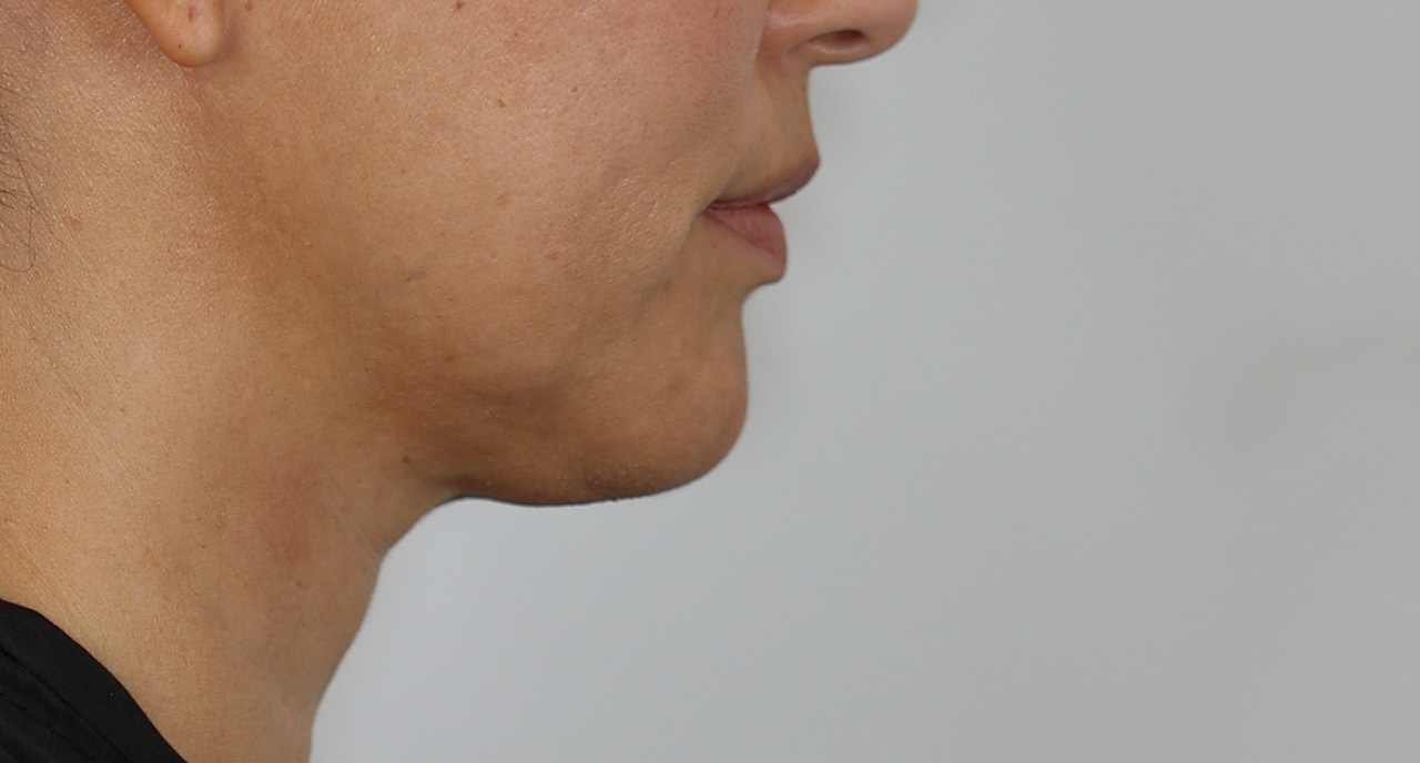 Neck (Under Chin) Liposuction
