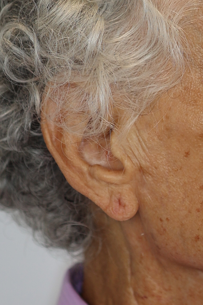 Earlobe Repair & Reduction