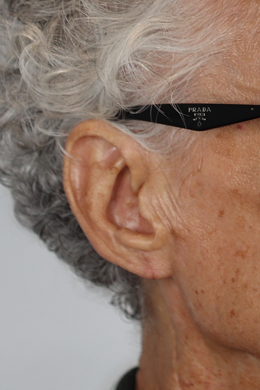 Earlobe Repair & Reduction