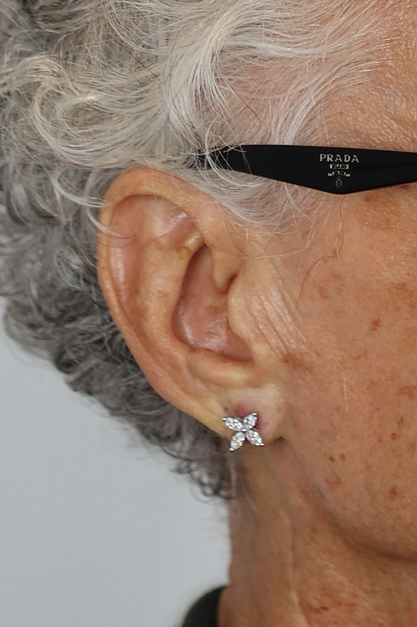 Earlobe Repair & Reduction