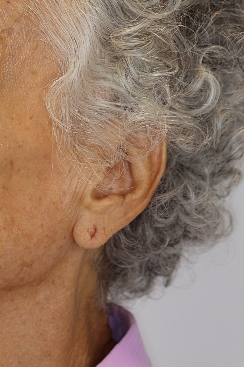 Earlobe Repair & Reduction