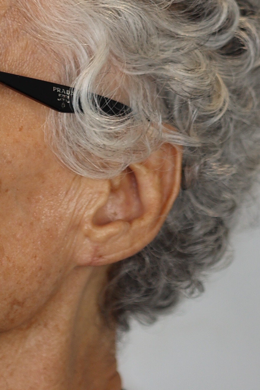 Earlobe Repair & Reduction