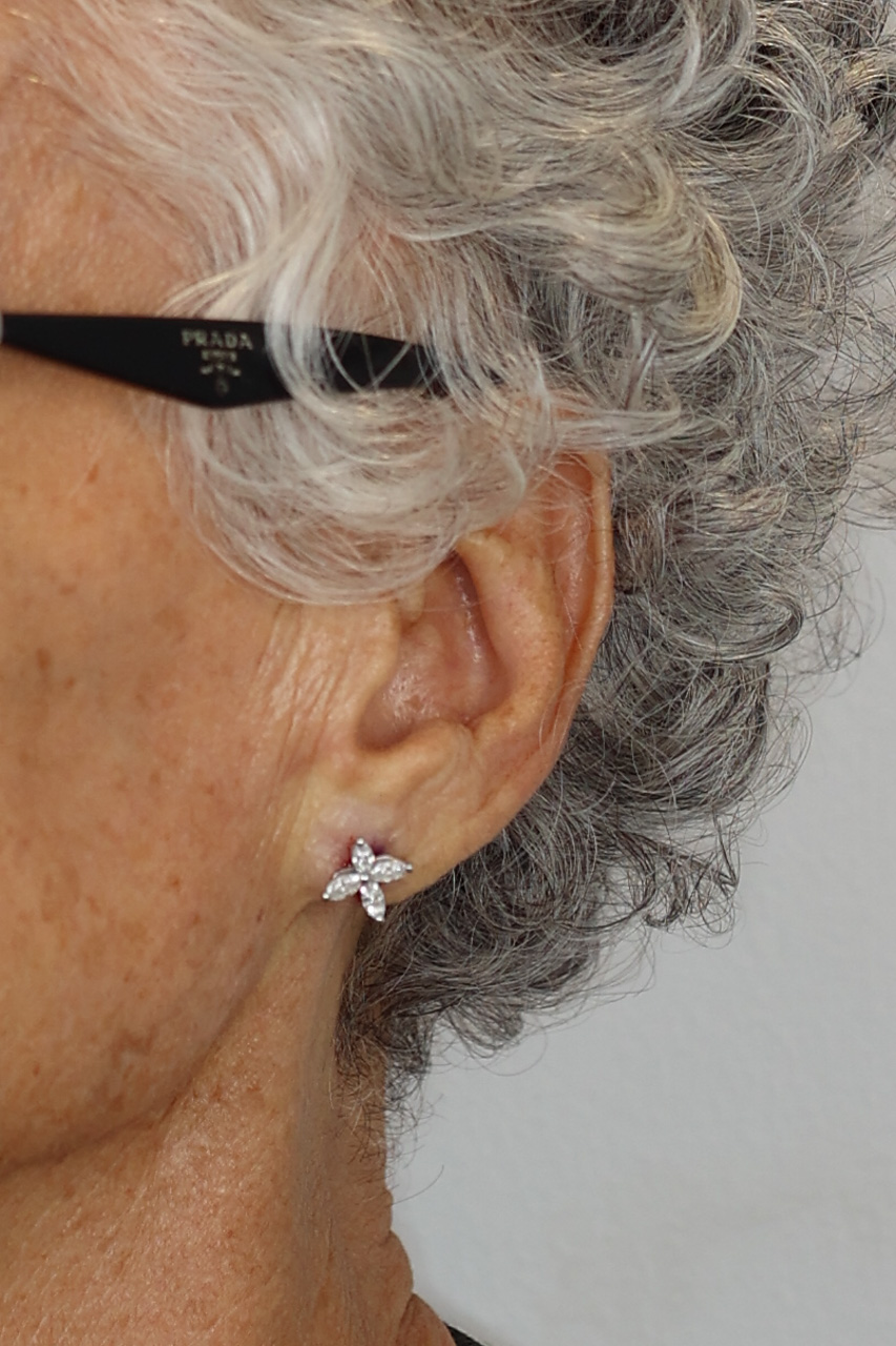 Earlobe Repair & Reduction