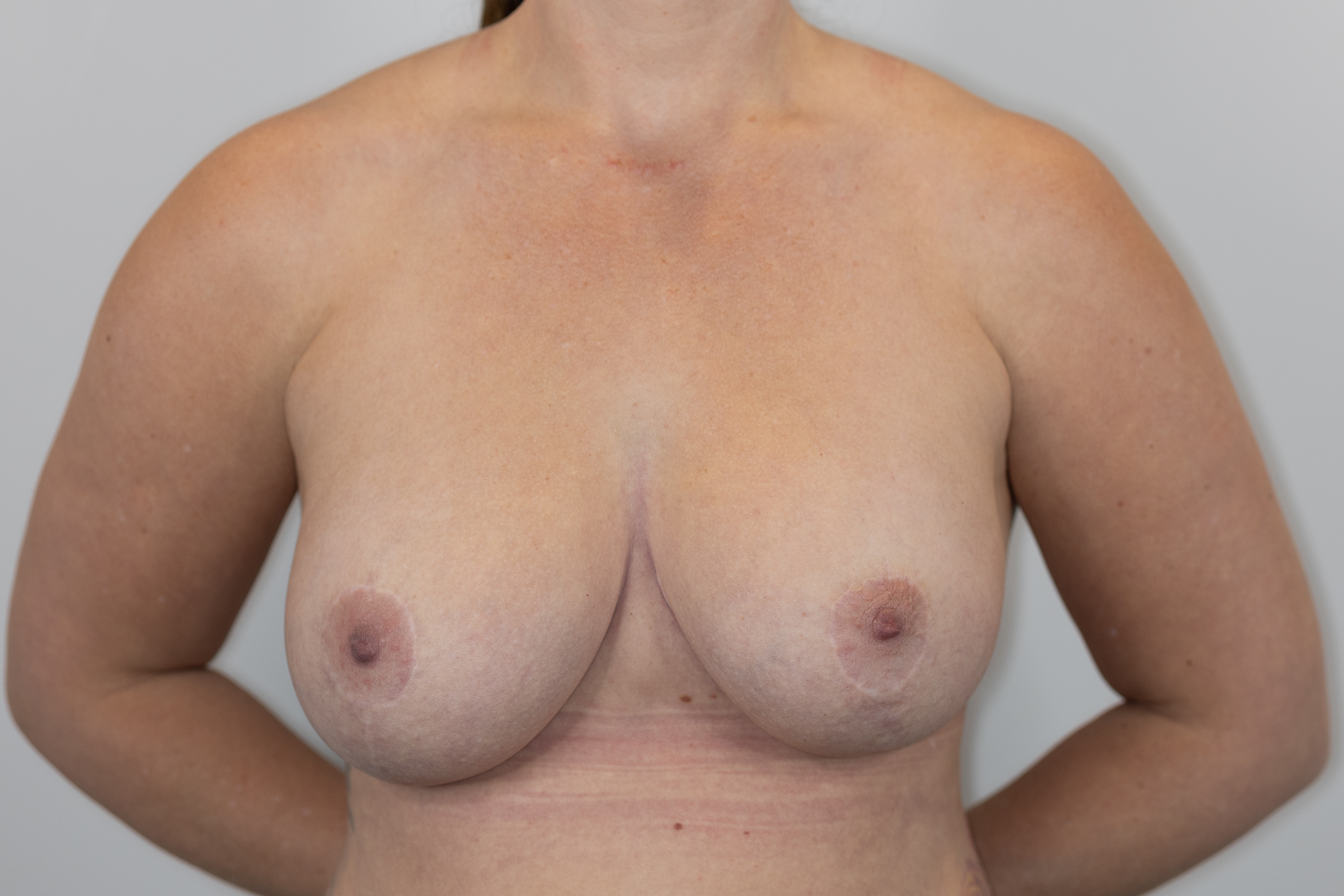 Breast Lift Revision with Implant Exchange & Internal Bra