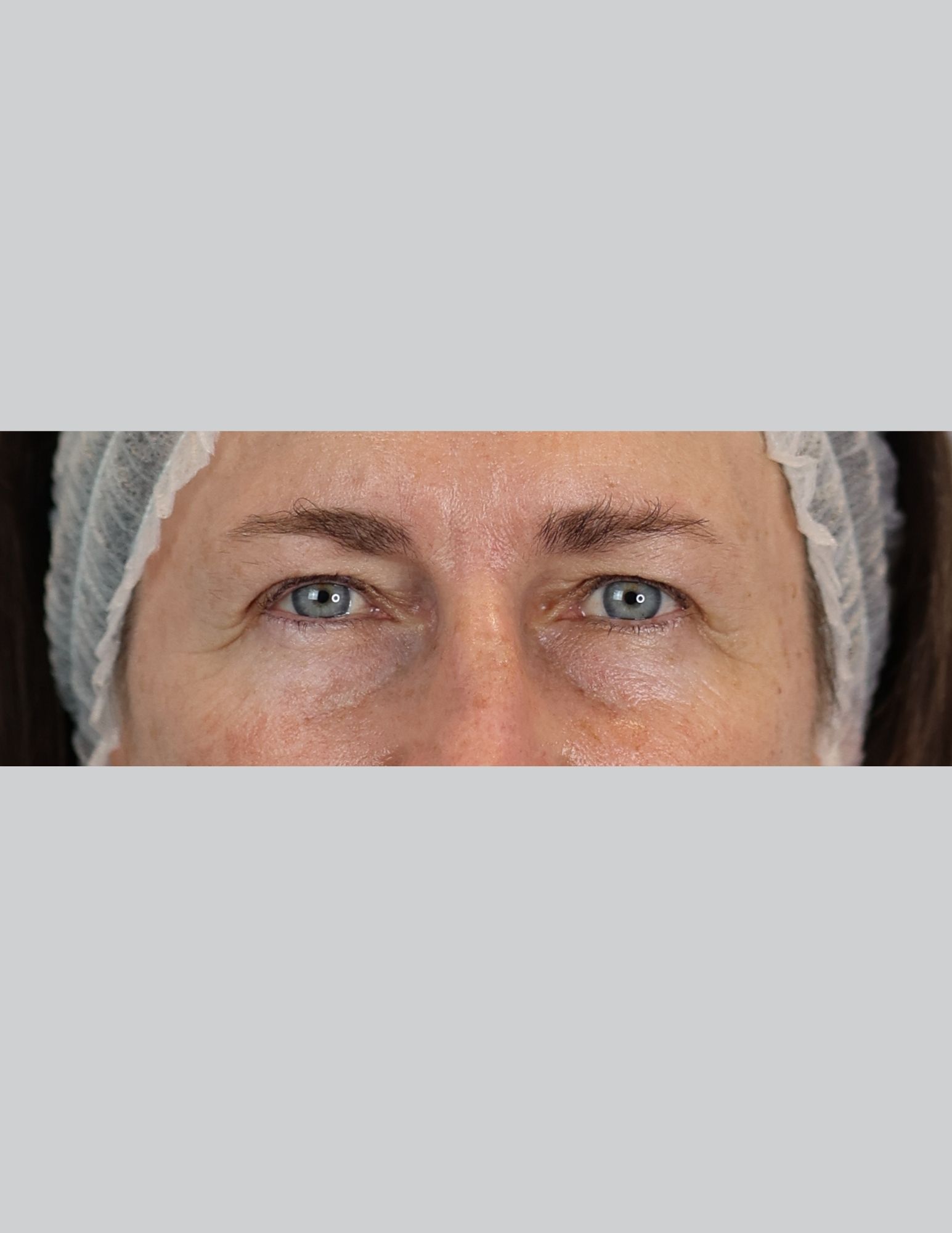 Upper Blepharoplasty (Eyelid Lift)