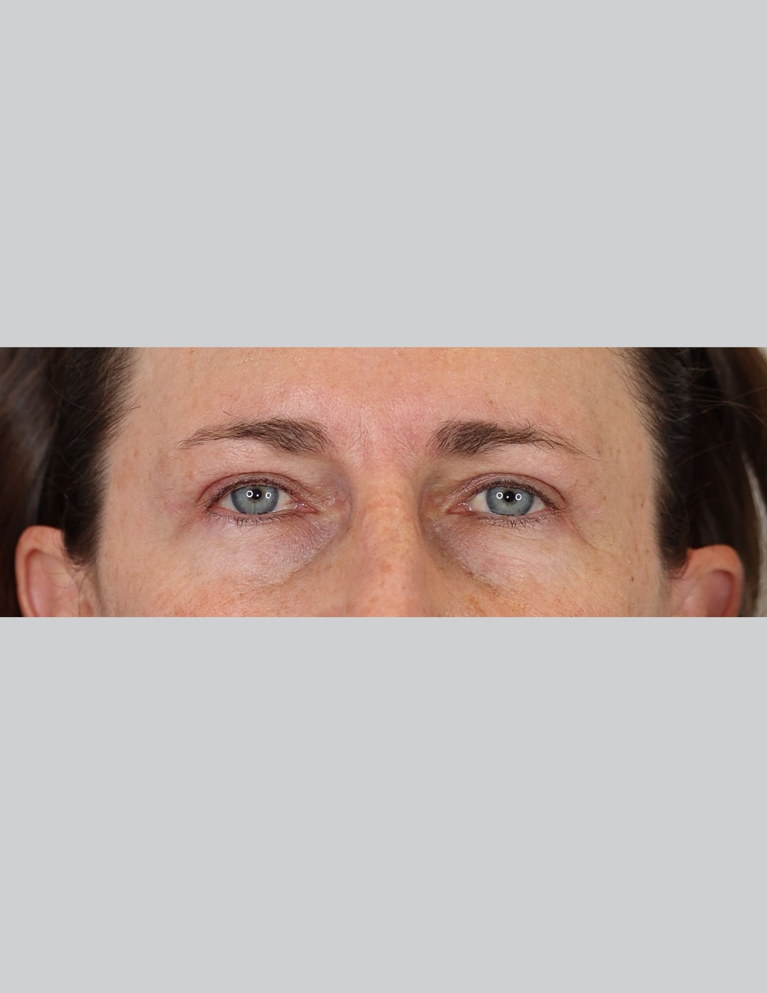 Upper Blepharoplasty (Eyelid Lift)