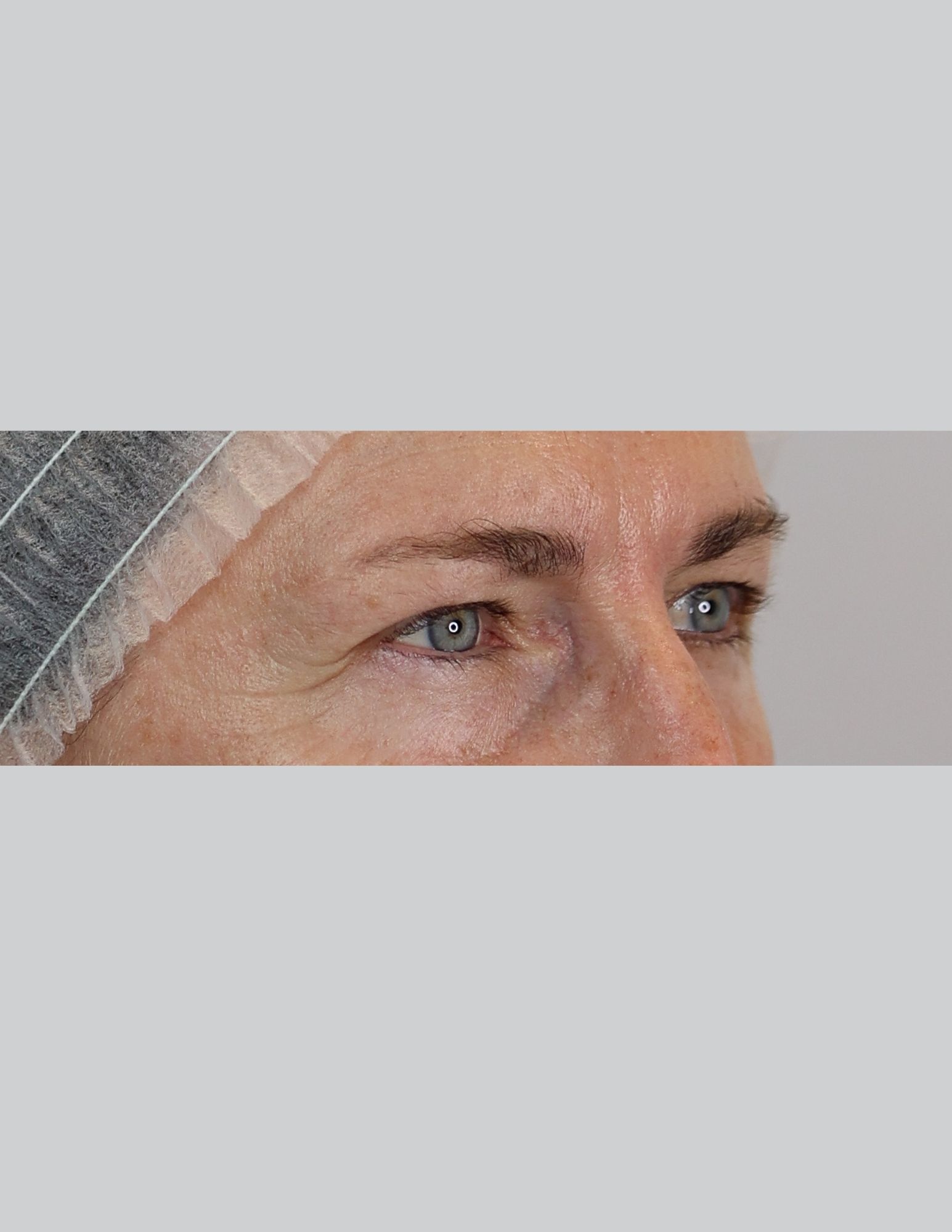 Upper Blepharoplasty (Eyelid Lift)