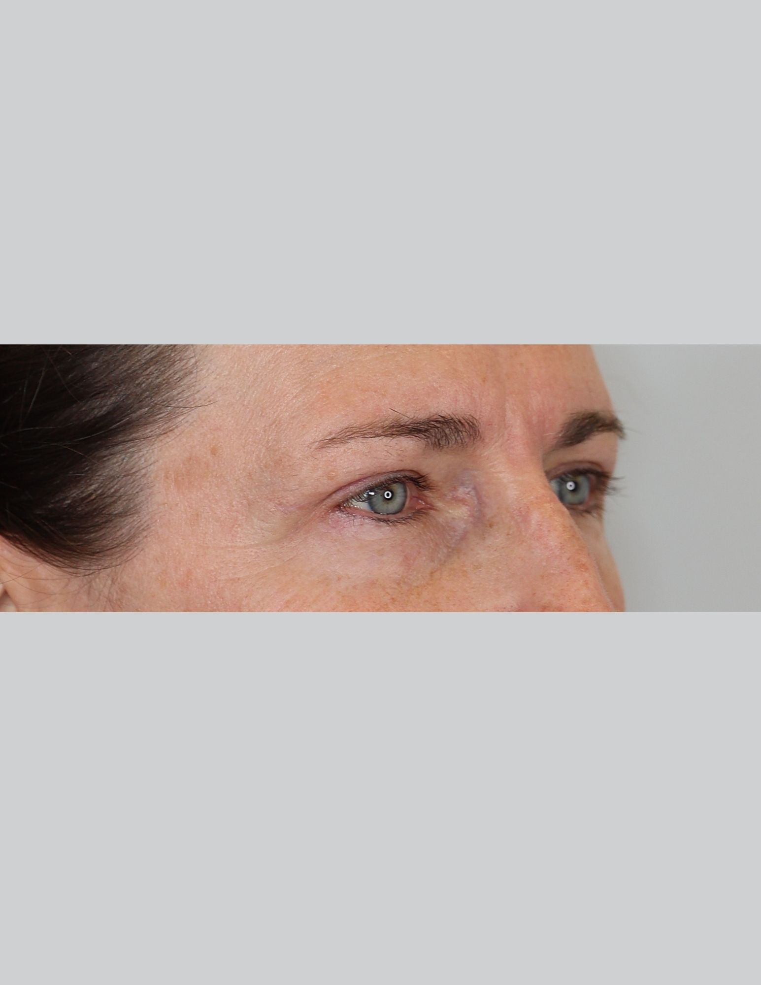 Upper Blepharoplasty (Eyelid Lift)