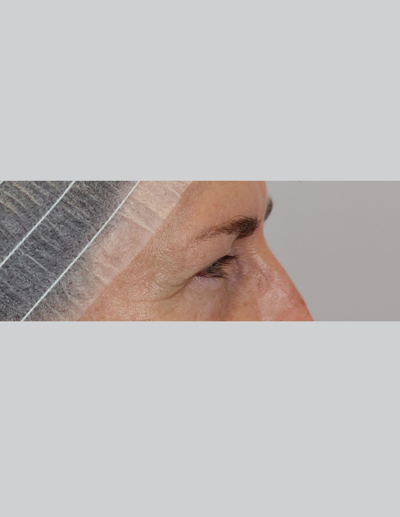 Upper Blepharoplasty (Eyelid Lift)