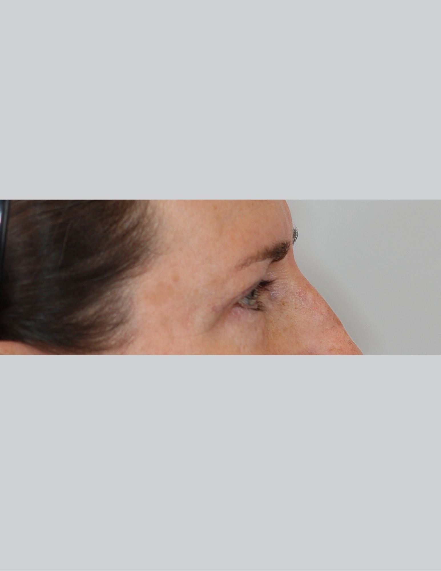 Upper Blepharoplasty (Eyelid Lift)