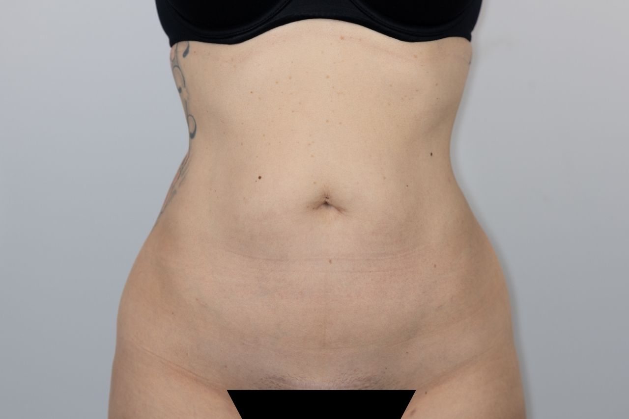 Tummy Tuck