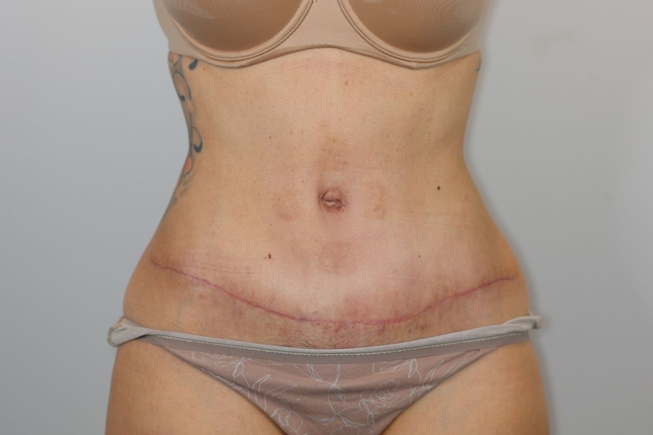 Tummy Tuck