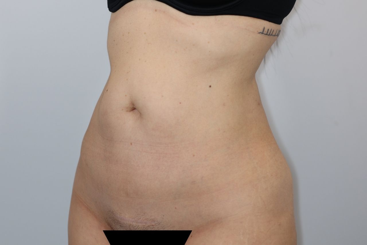 Tummy Tuck