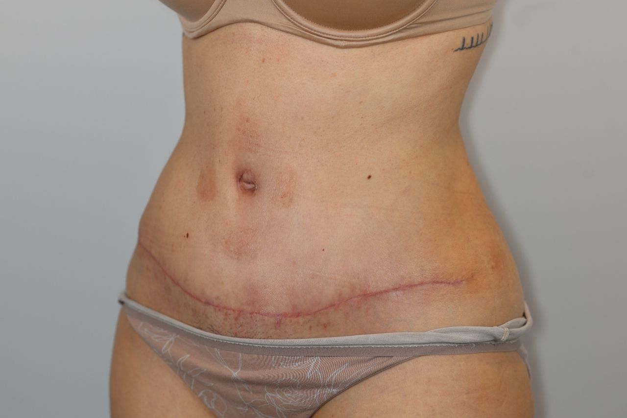 Tummy Tuck