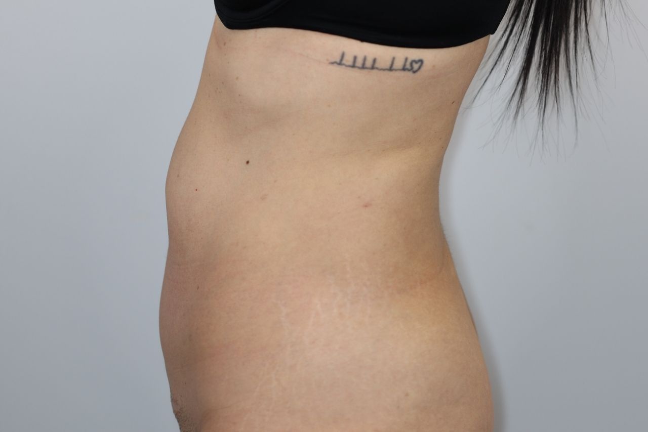 Tummy Tuck