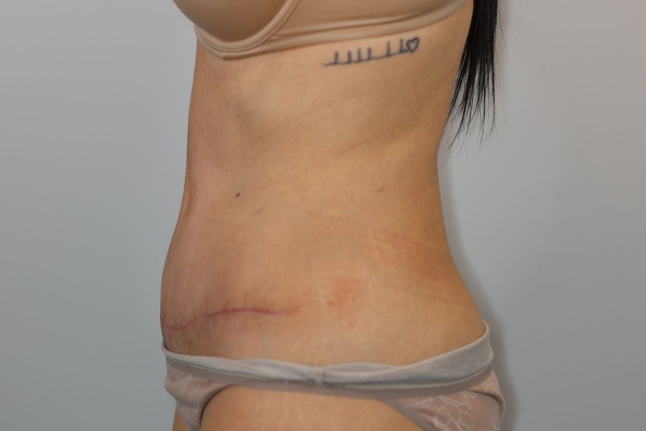 Tummy Tuck