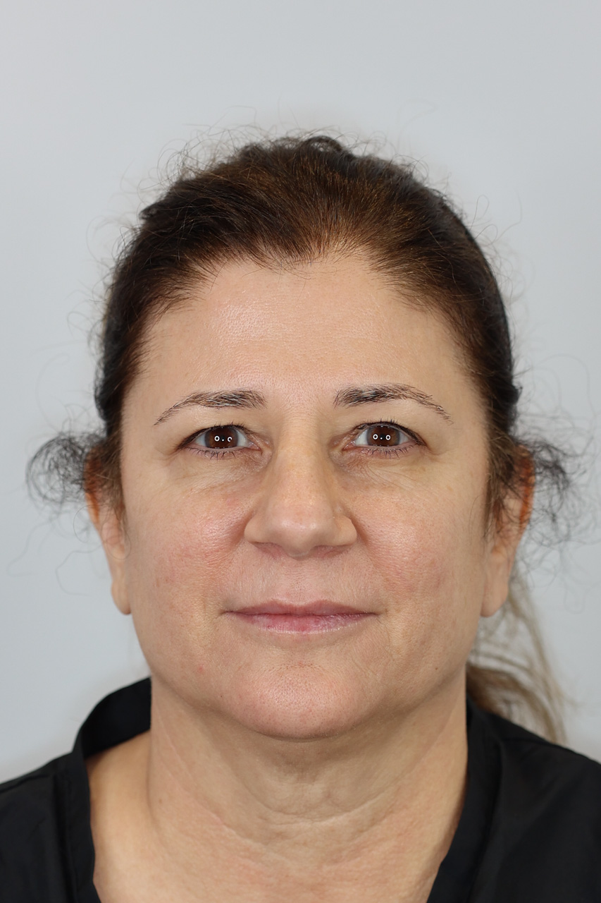 Upper Blepharoplasty & Brow Lift