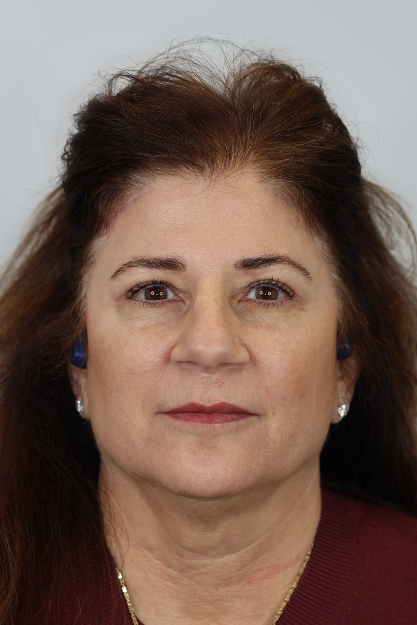 Upper Blepharoplasty & Brow Lift