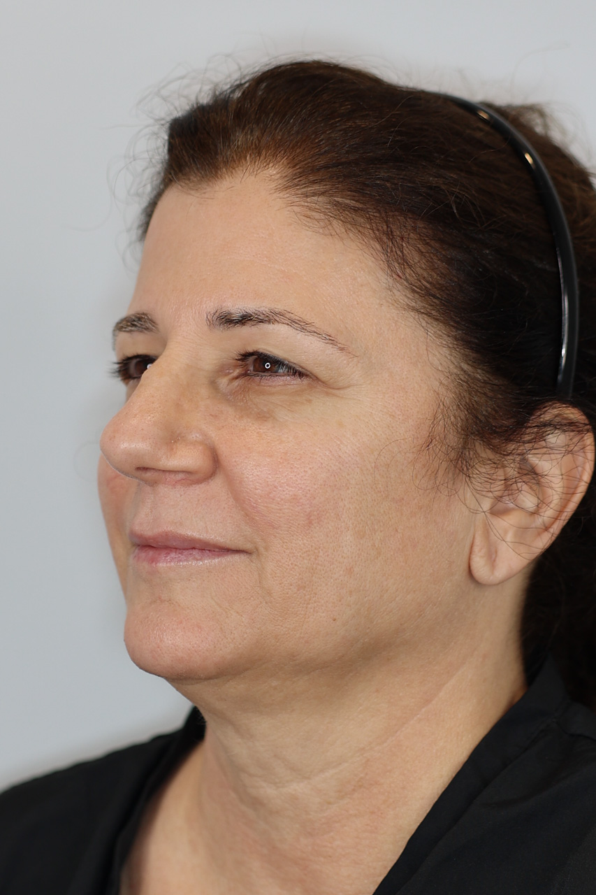 Upper Blepharoplasty & Brow Lift