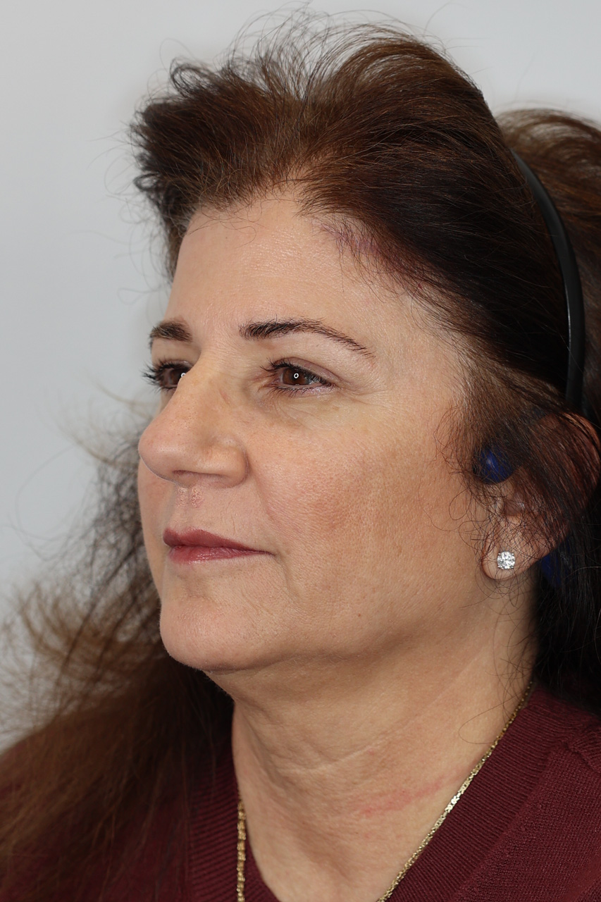 Upper Blepharoplasty & Brow Lift