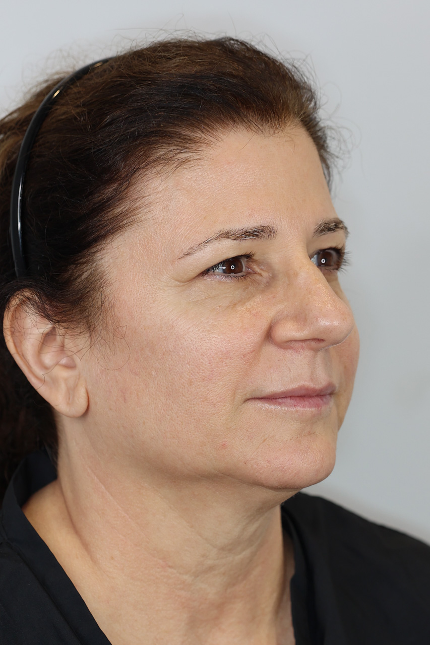 Upper Blepharoplasty & Brow Lift