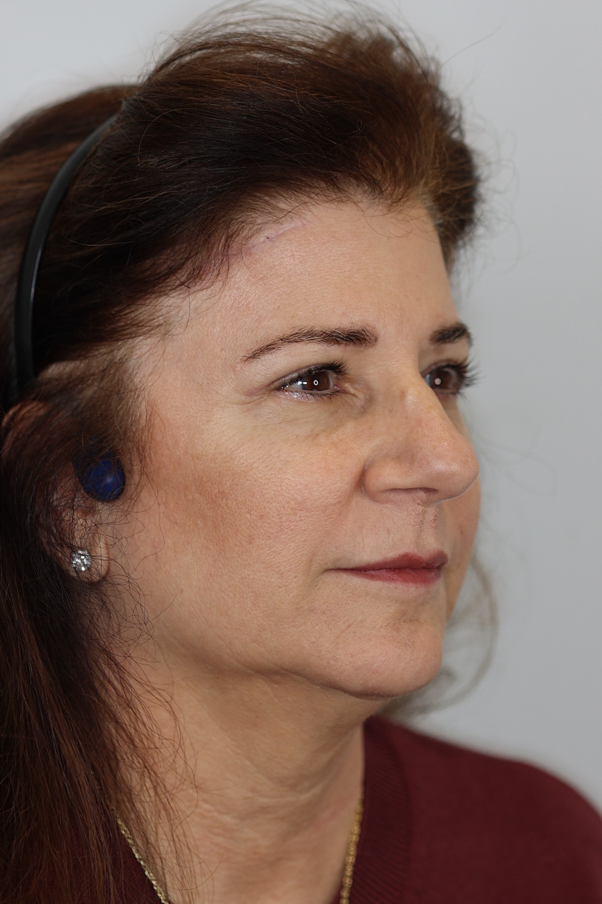 Upper Blepharoplasty & Brow Lift