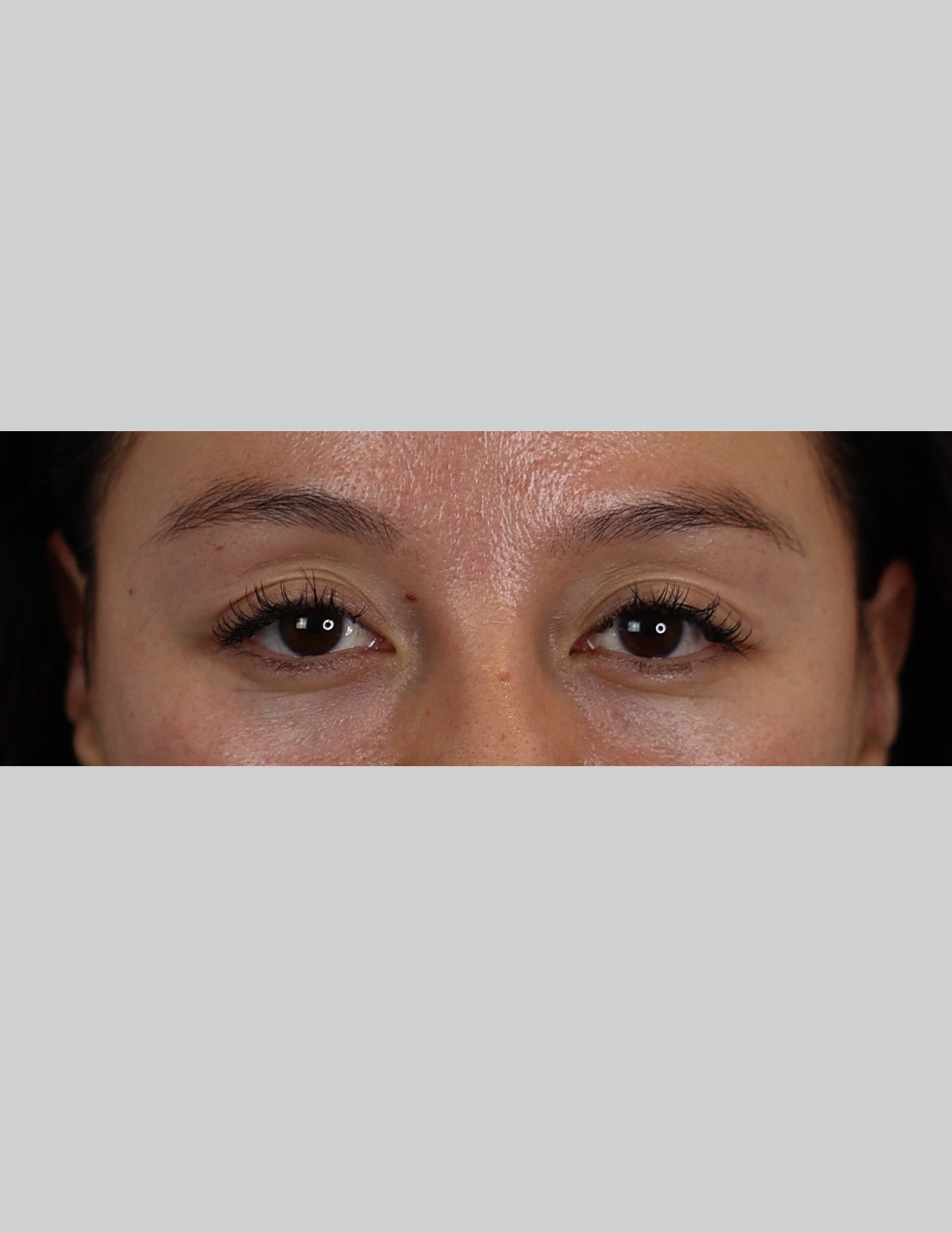 Upper Blepharoplasty (Upper Eyelid Lift)