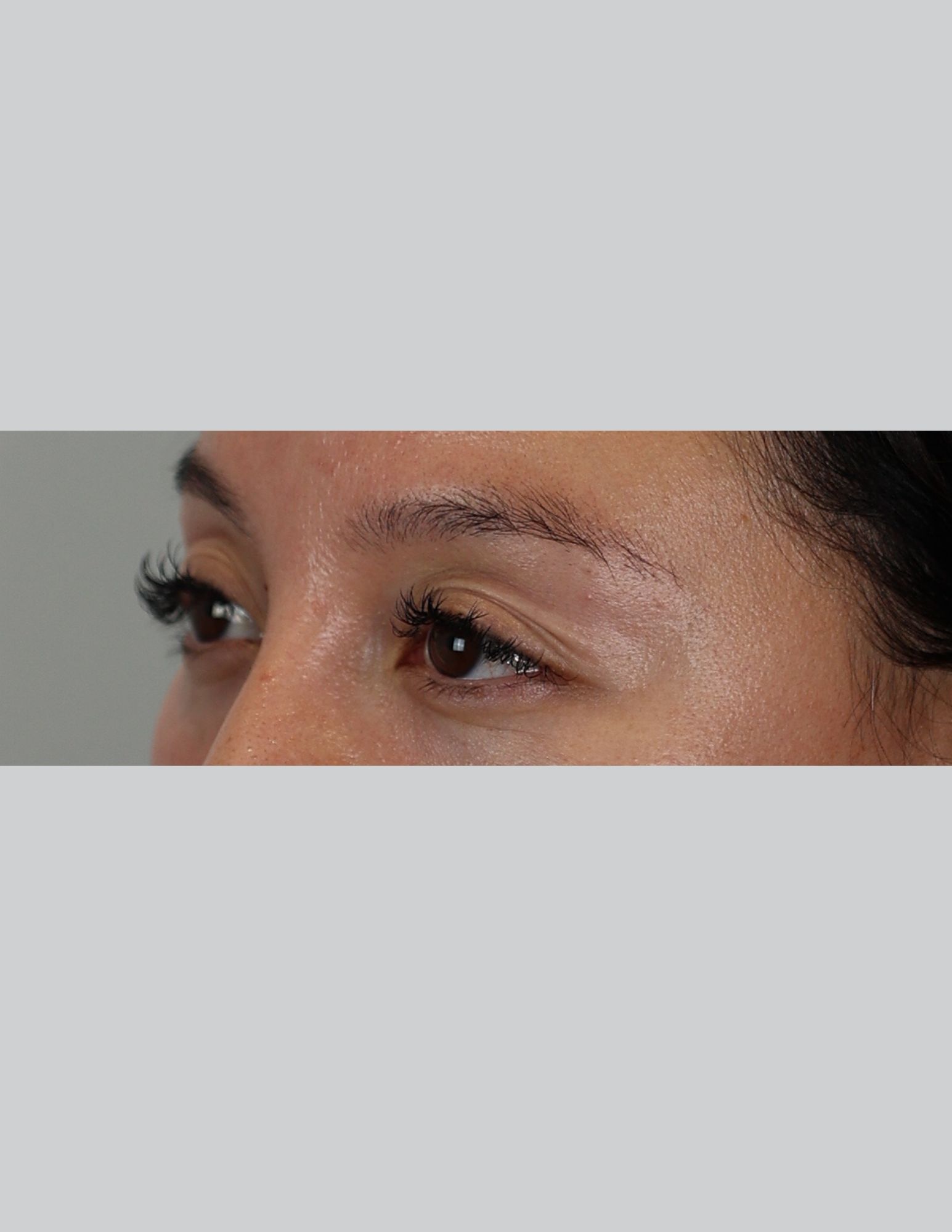 Upper Blepharoplasty (Upper Eyelid Lift)