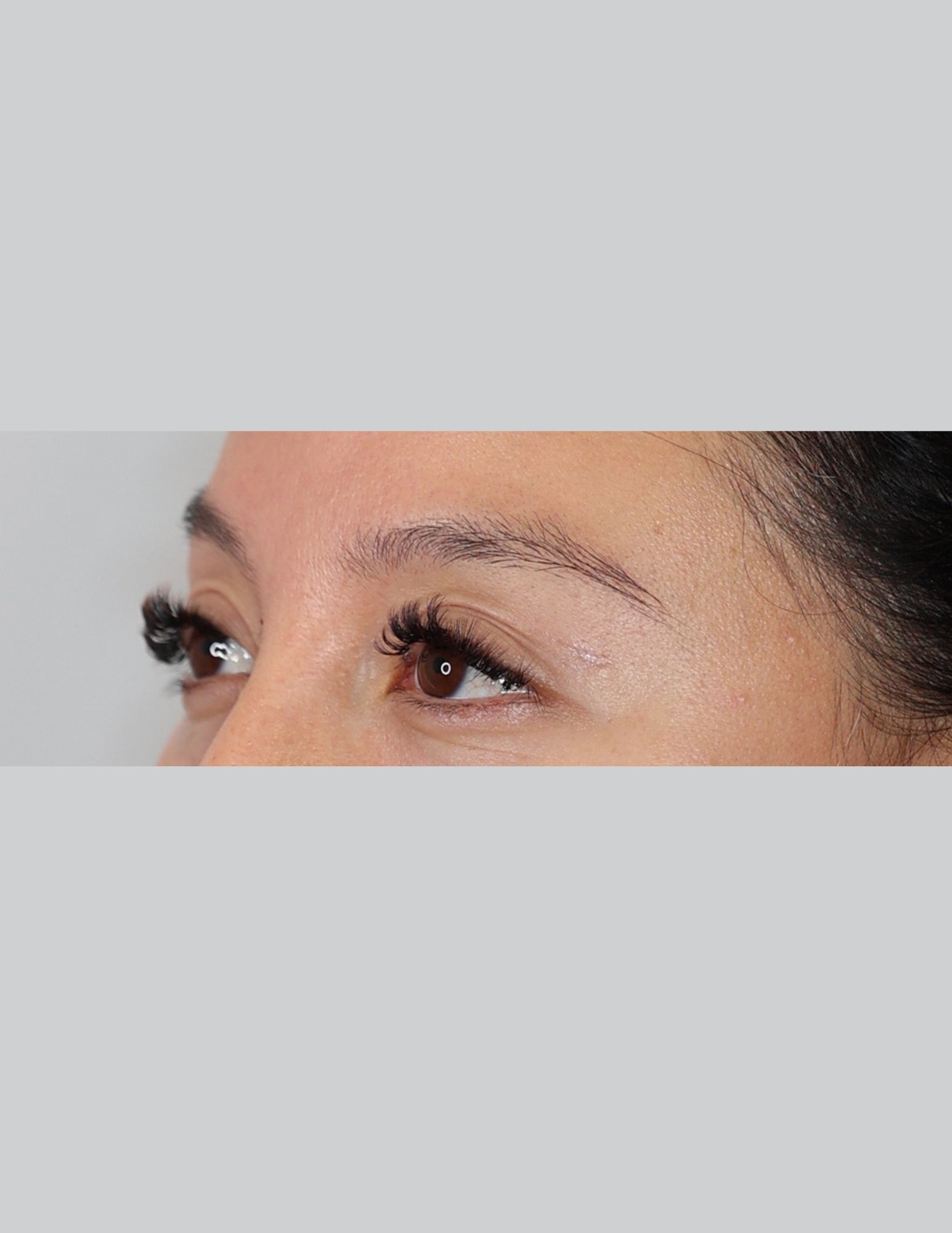 Upper Blepharoplasty (Upper Eyelid Lift)