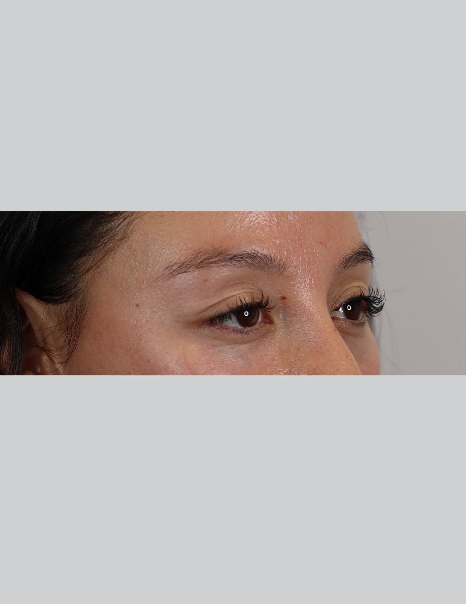 Upper Blepharoplasty (Upper Eyelid Lift)