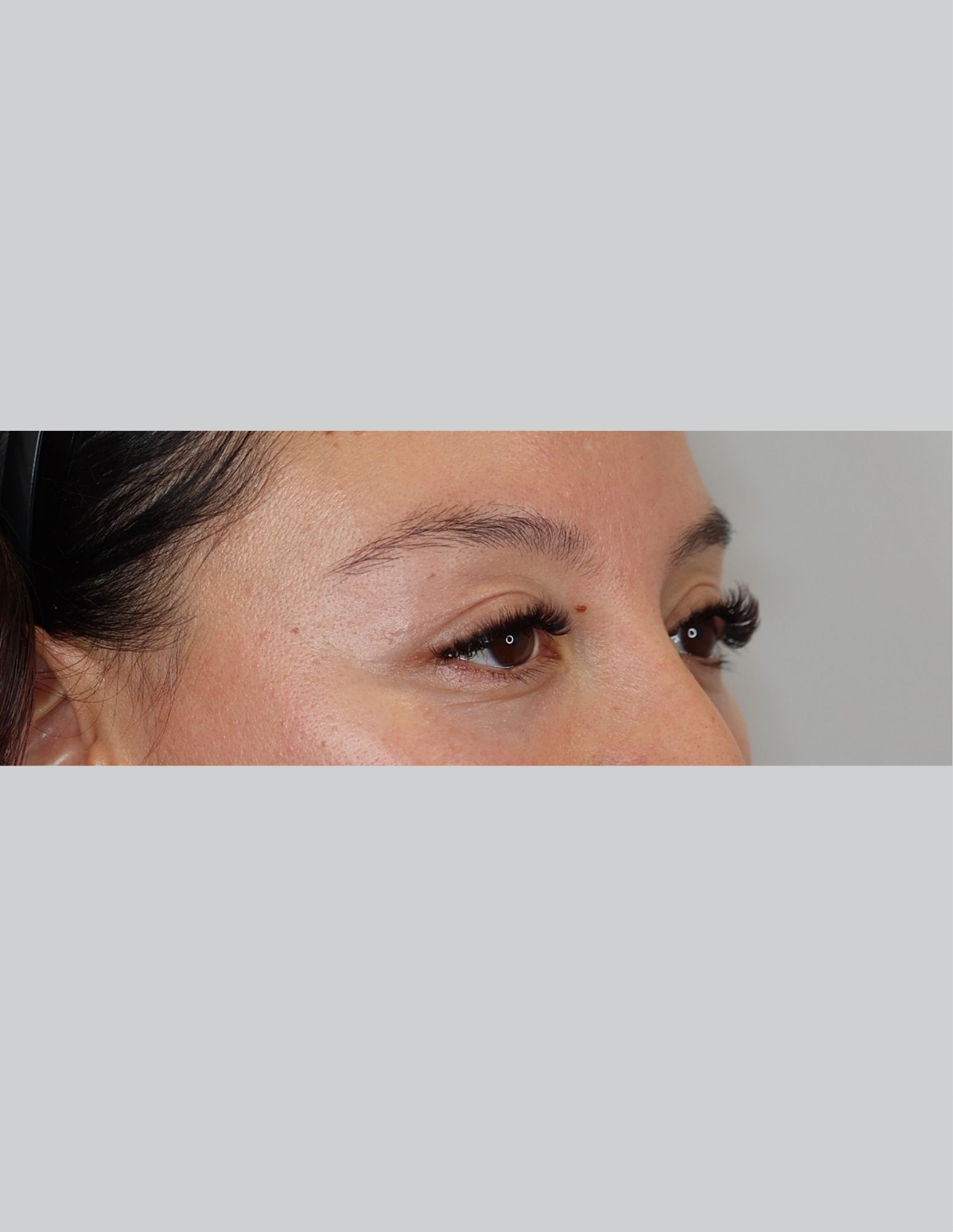 Upper Blepharoplasty (Upper Eyelid Lift)