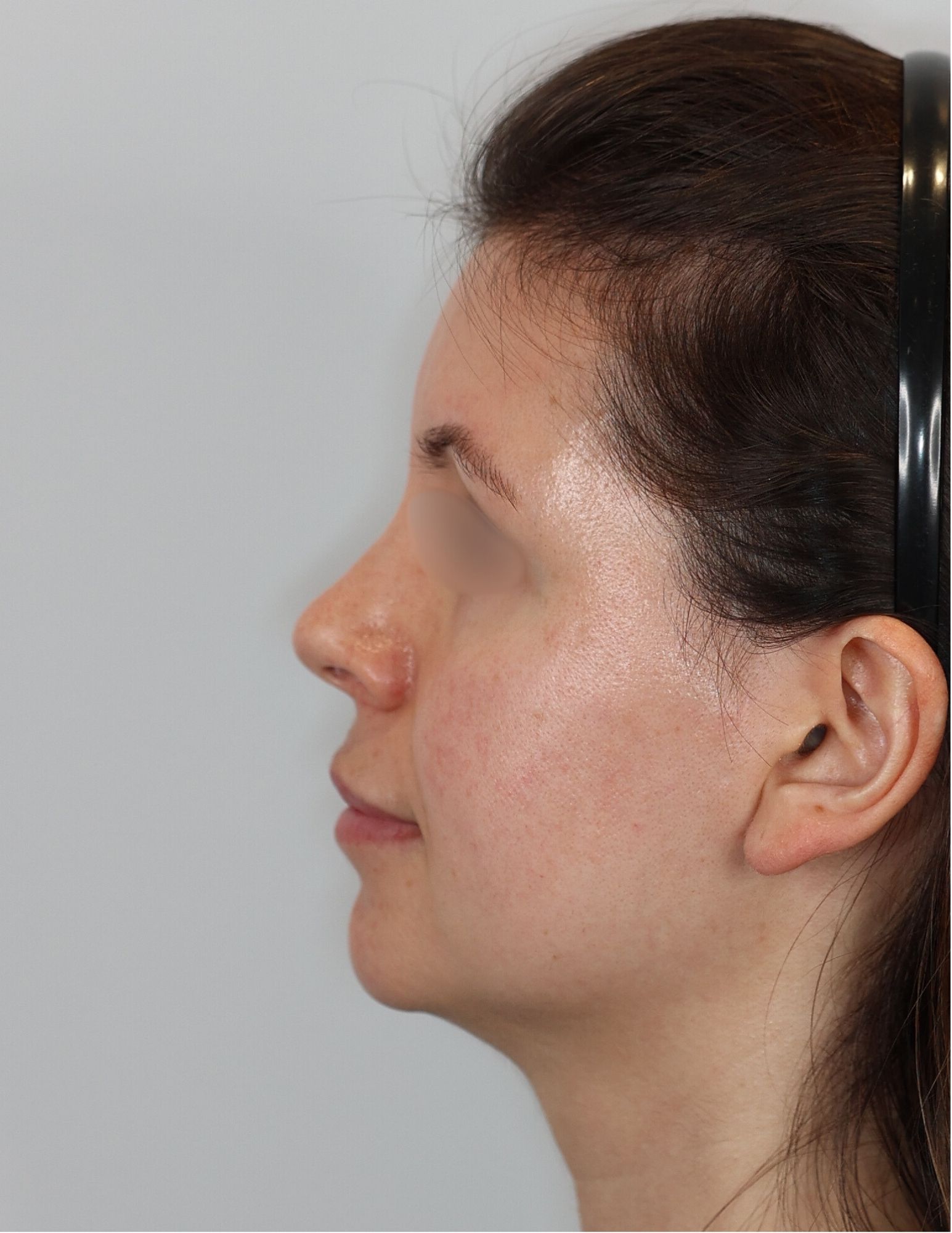 Facial Fat Grafting