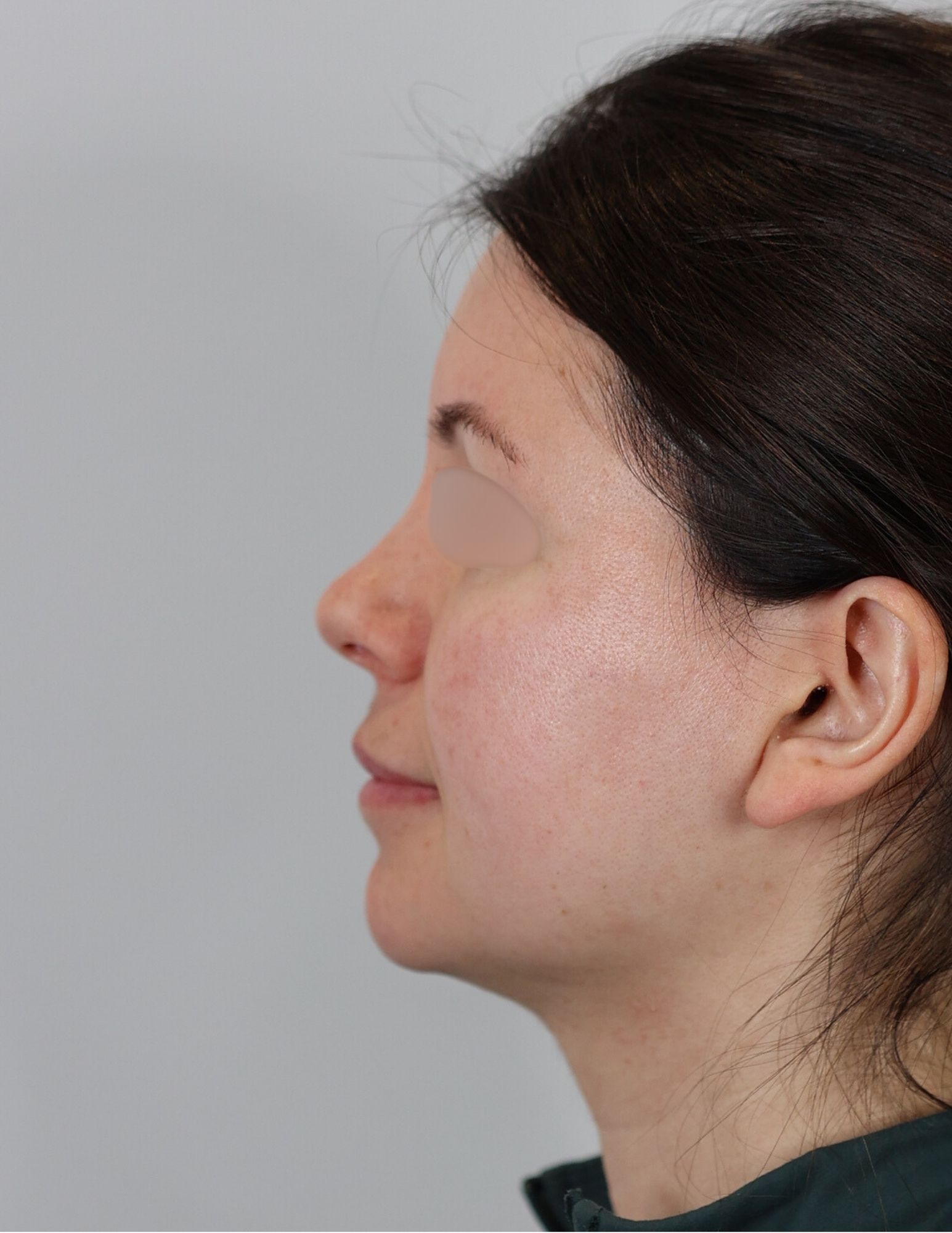 Facial Fat Grafting