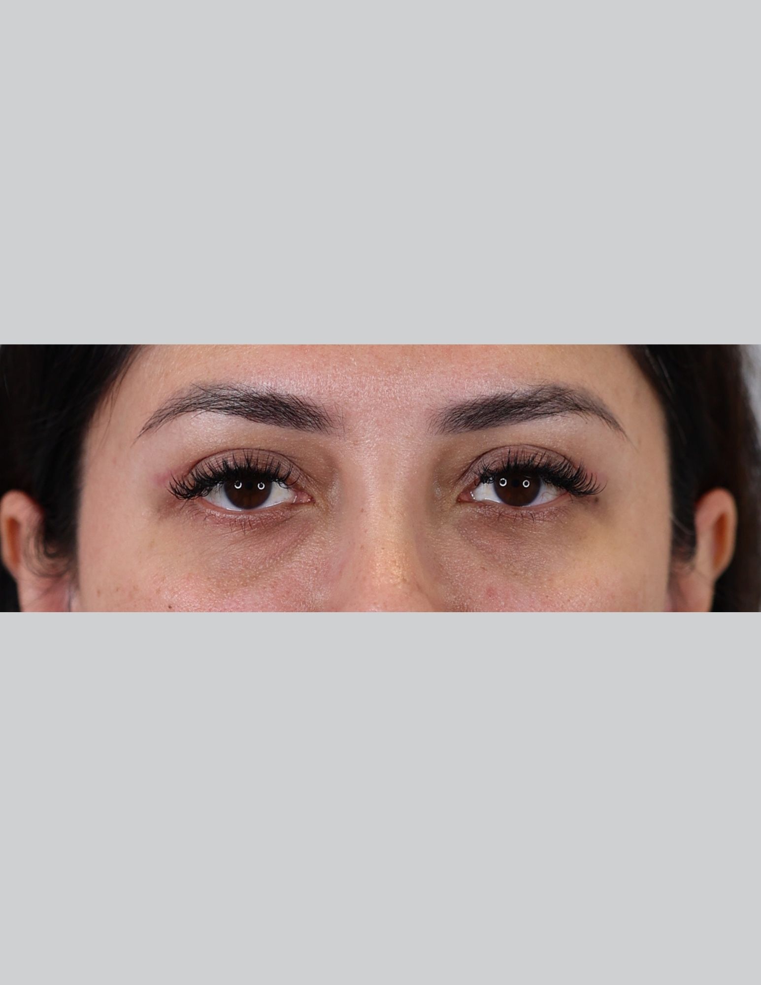 Upper Blepharoplasty (Upper Eyelid Lift)
