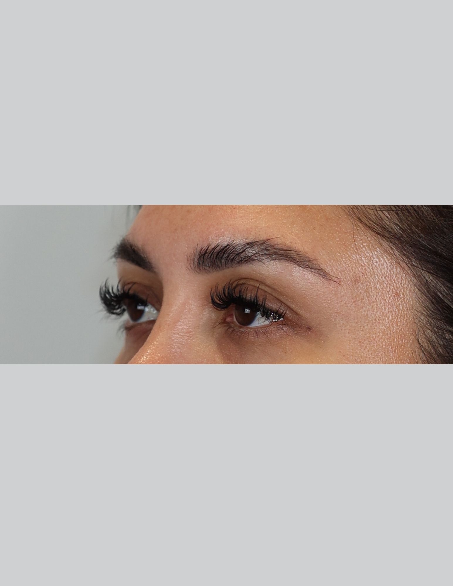Upper Blepharoplasty (Upper Eyelid Lift)