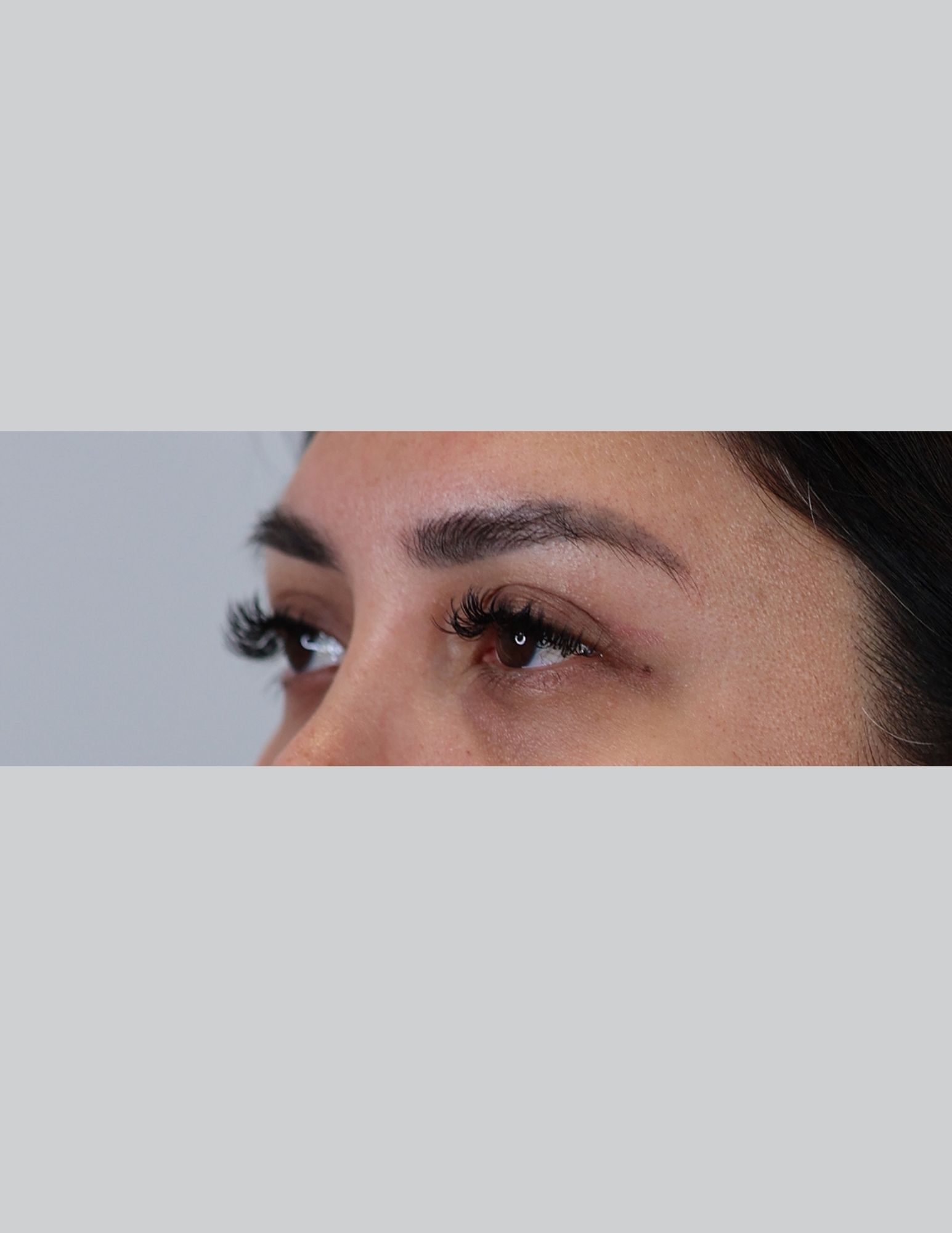 Upper Blepharoplasty (Upper Eyelid Lift)