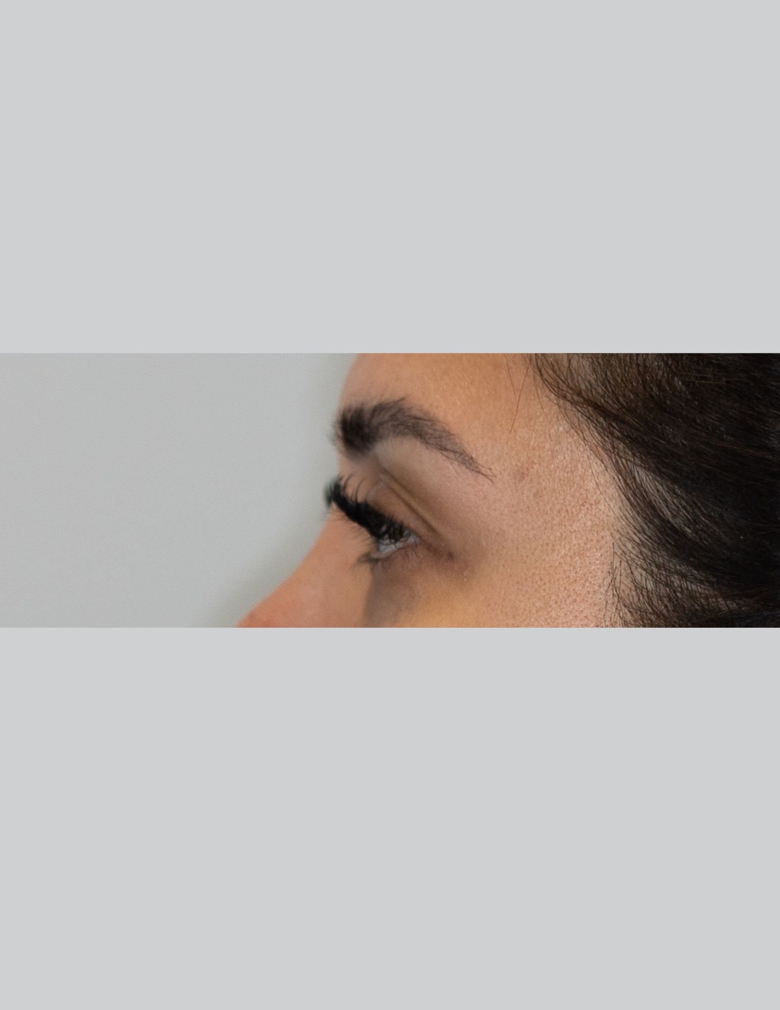 Upper Blepharoplasty (Upper Eyelid Lift)
