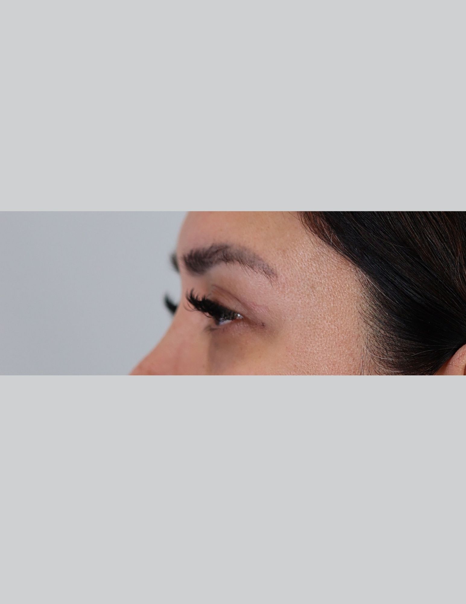 Upper Blepharoplasty (Upper Eyelid Lift)