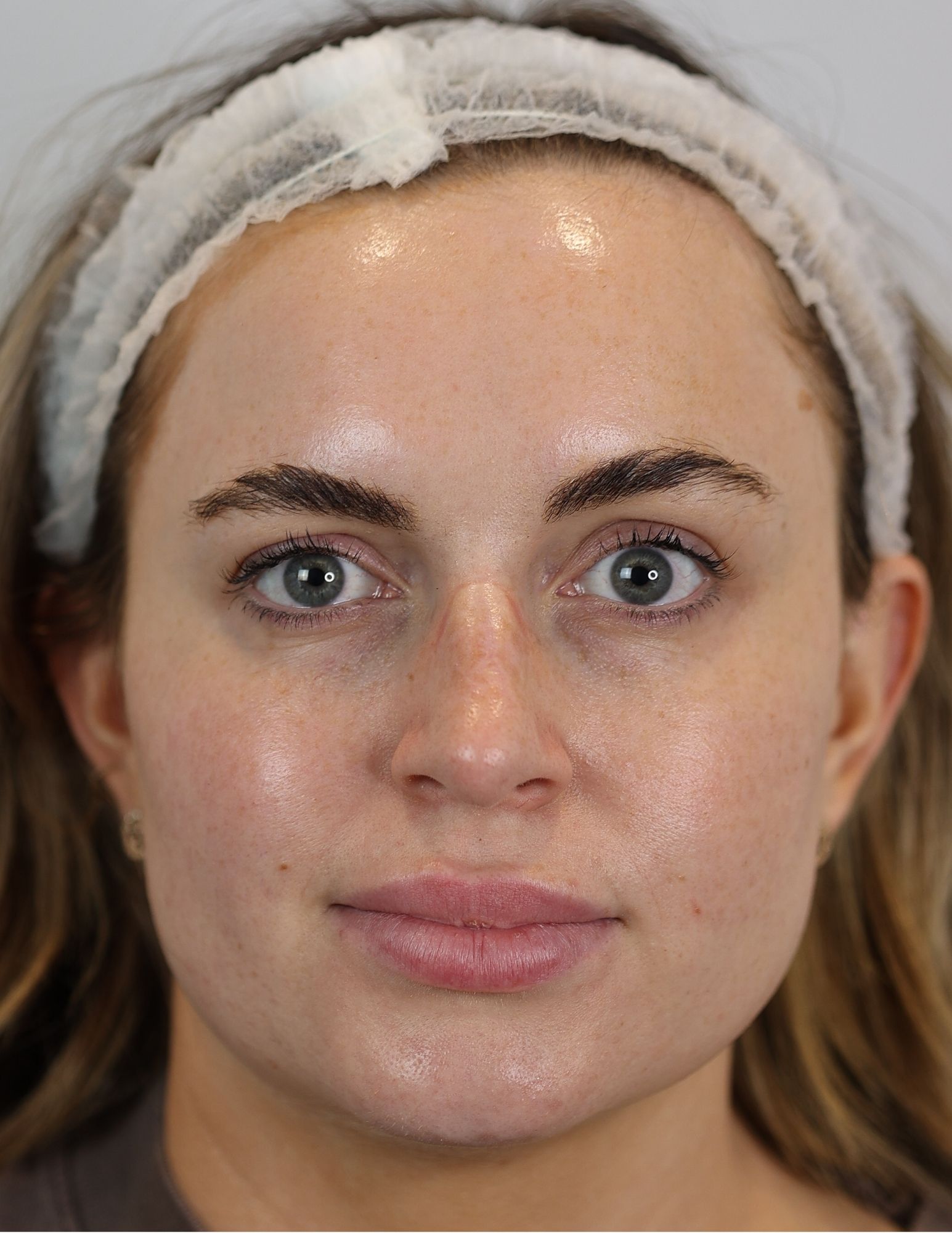 Upper Blepharoplasty (Eyelid Lift)