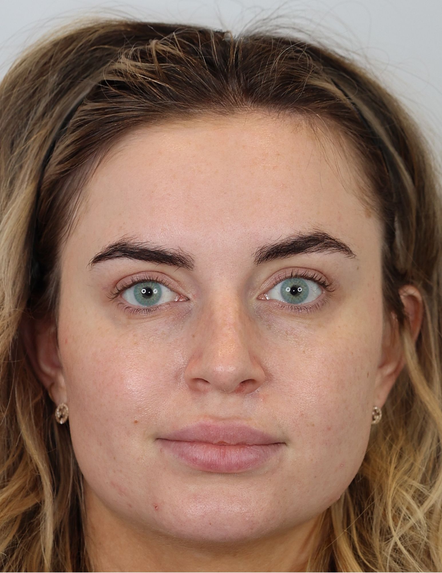 Upper Blepharoplasty (Eyelid Lift)