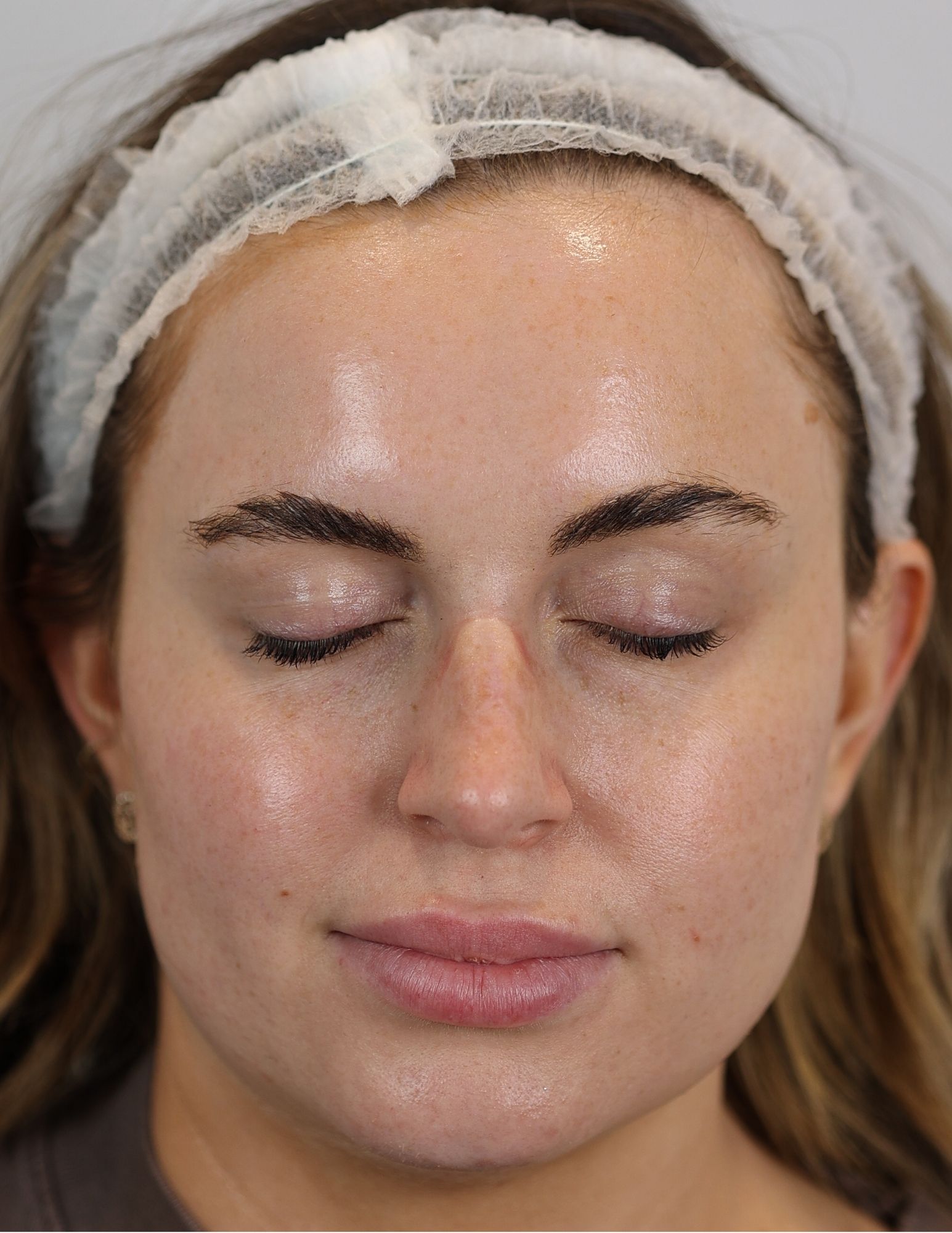 Upper Blepharoplasty (Eyelid Lift)