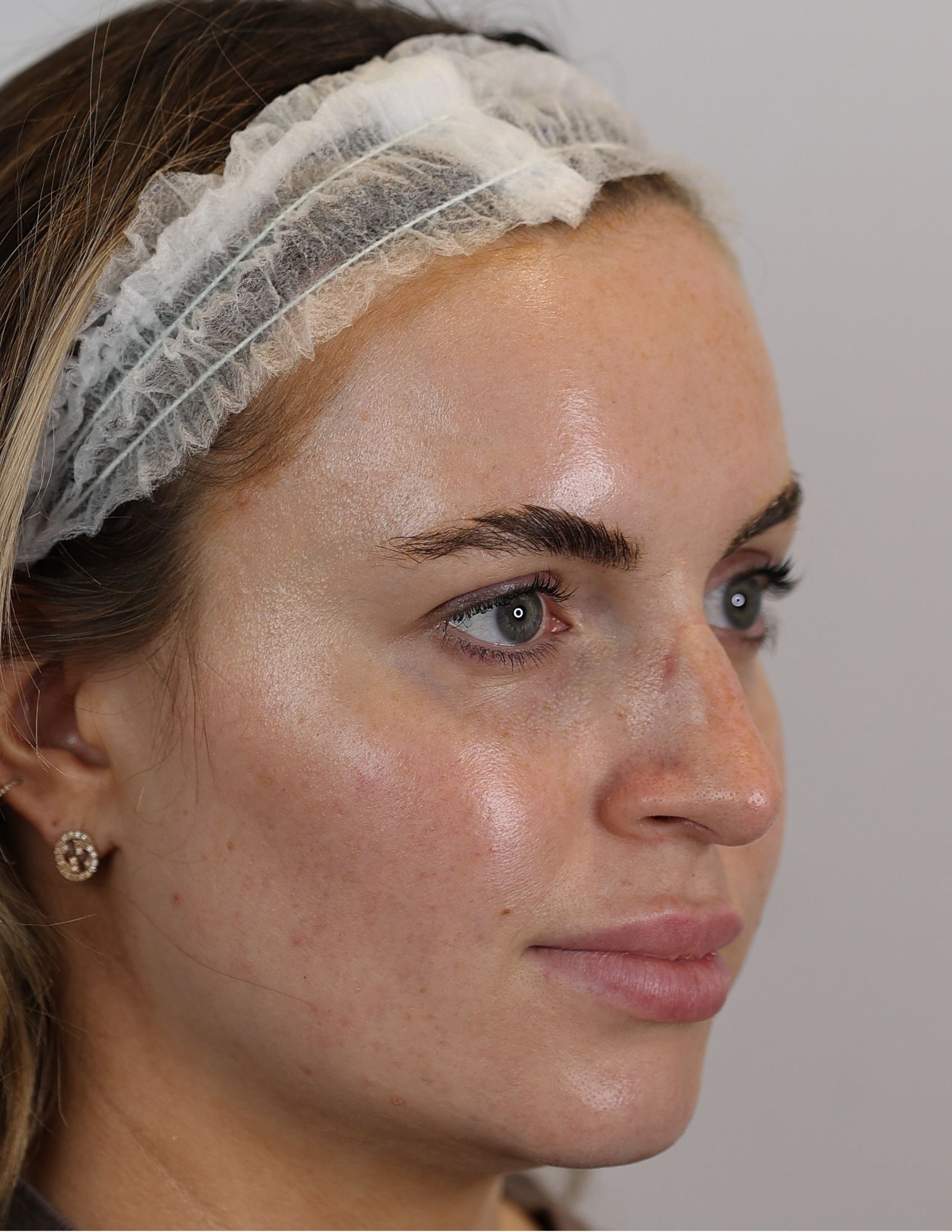 Upper Blepharoplasty (Eyelid Lift)