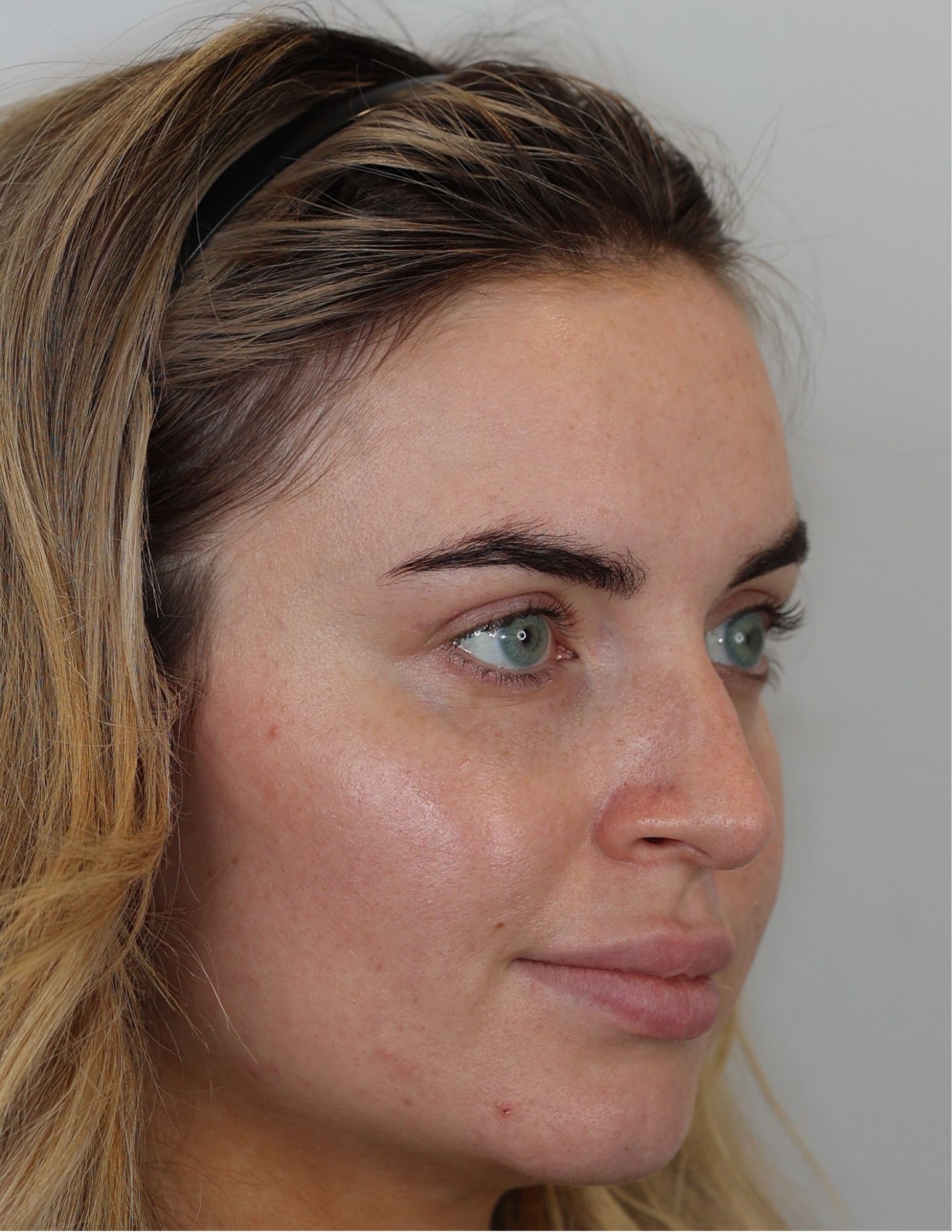 Upper Blepharoplasty (Eyelid Lift)