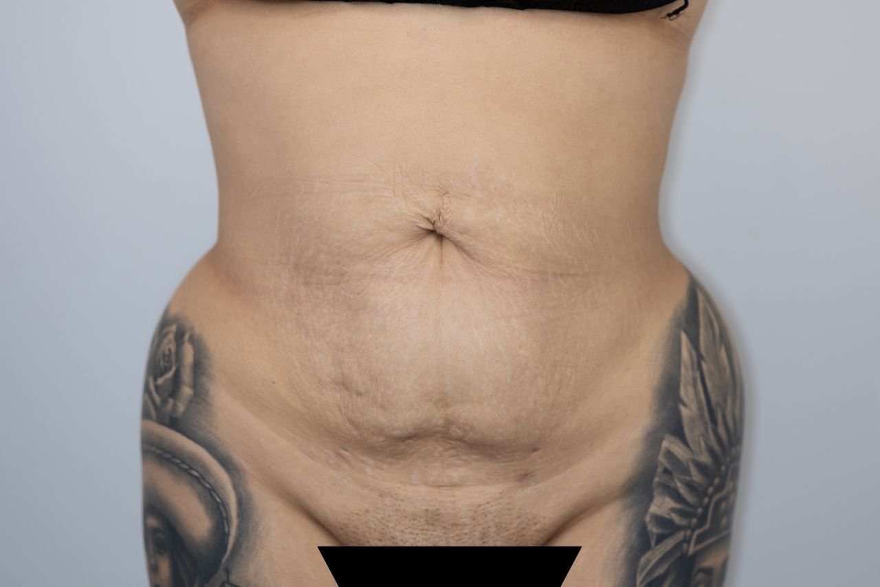 Tummy Tuck