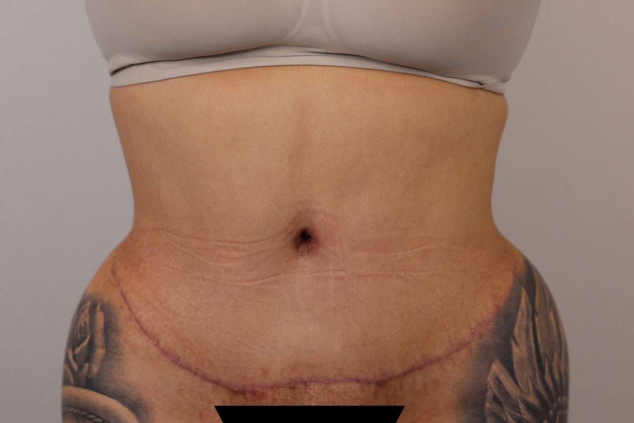Tummy Tuck