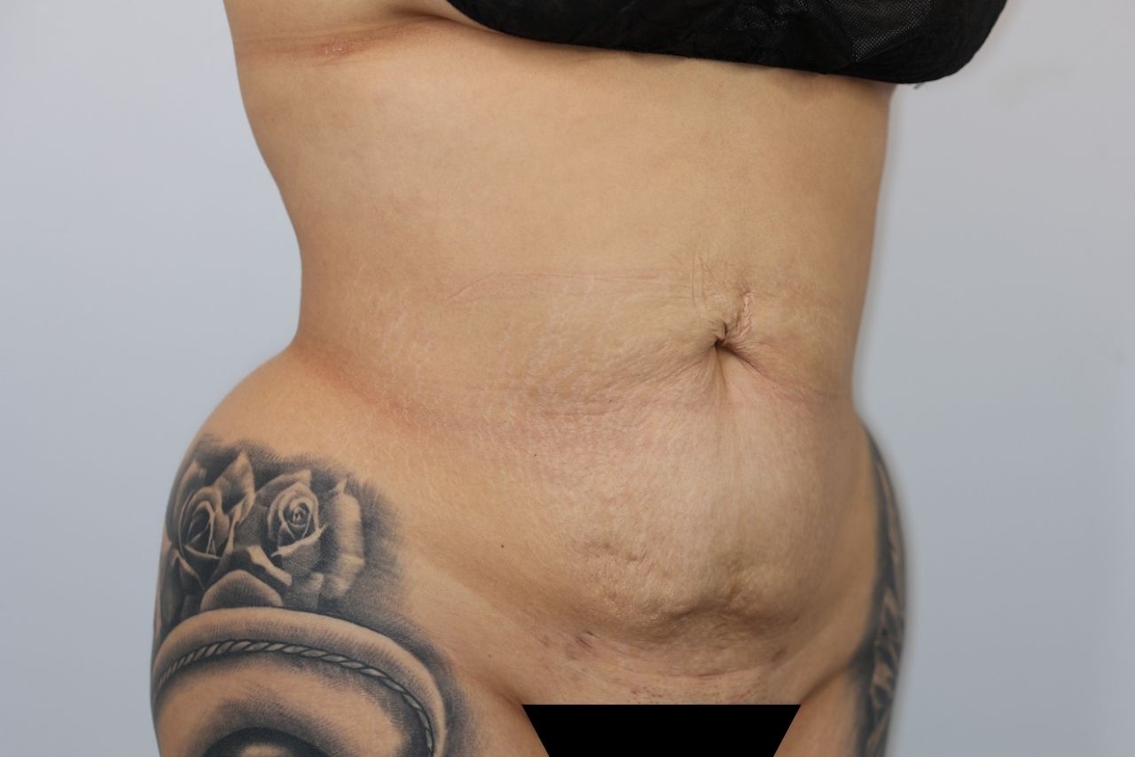 Tummy Tuck