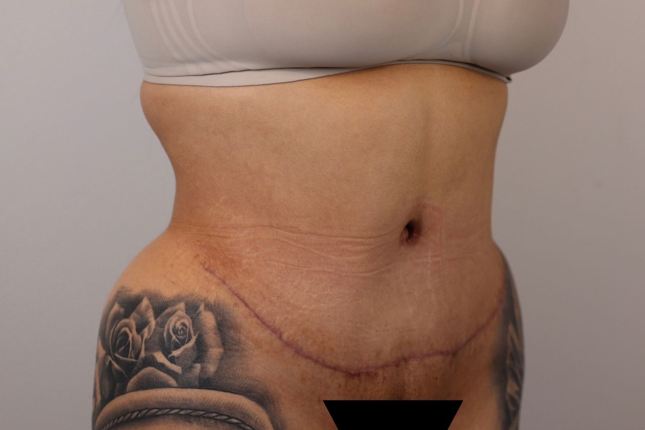 Tummy Tuck