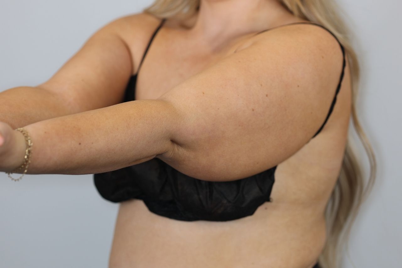 Arm Liposuction