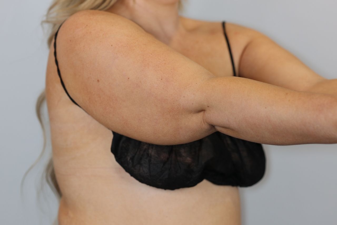 Arm Liposuction