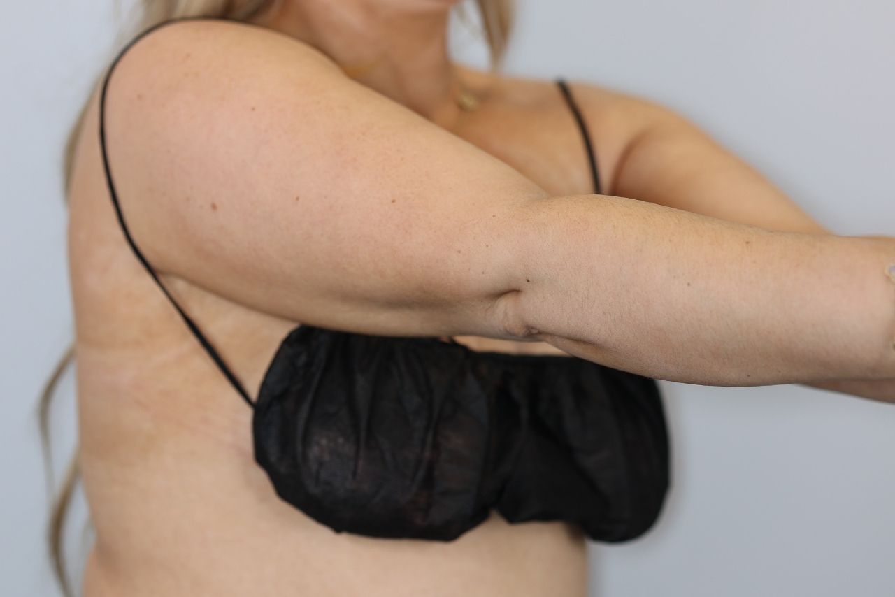 Arm Liposuction